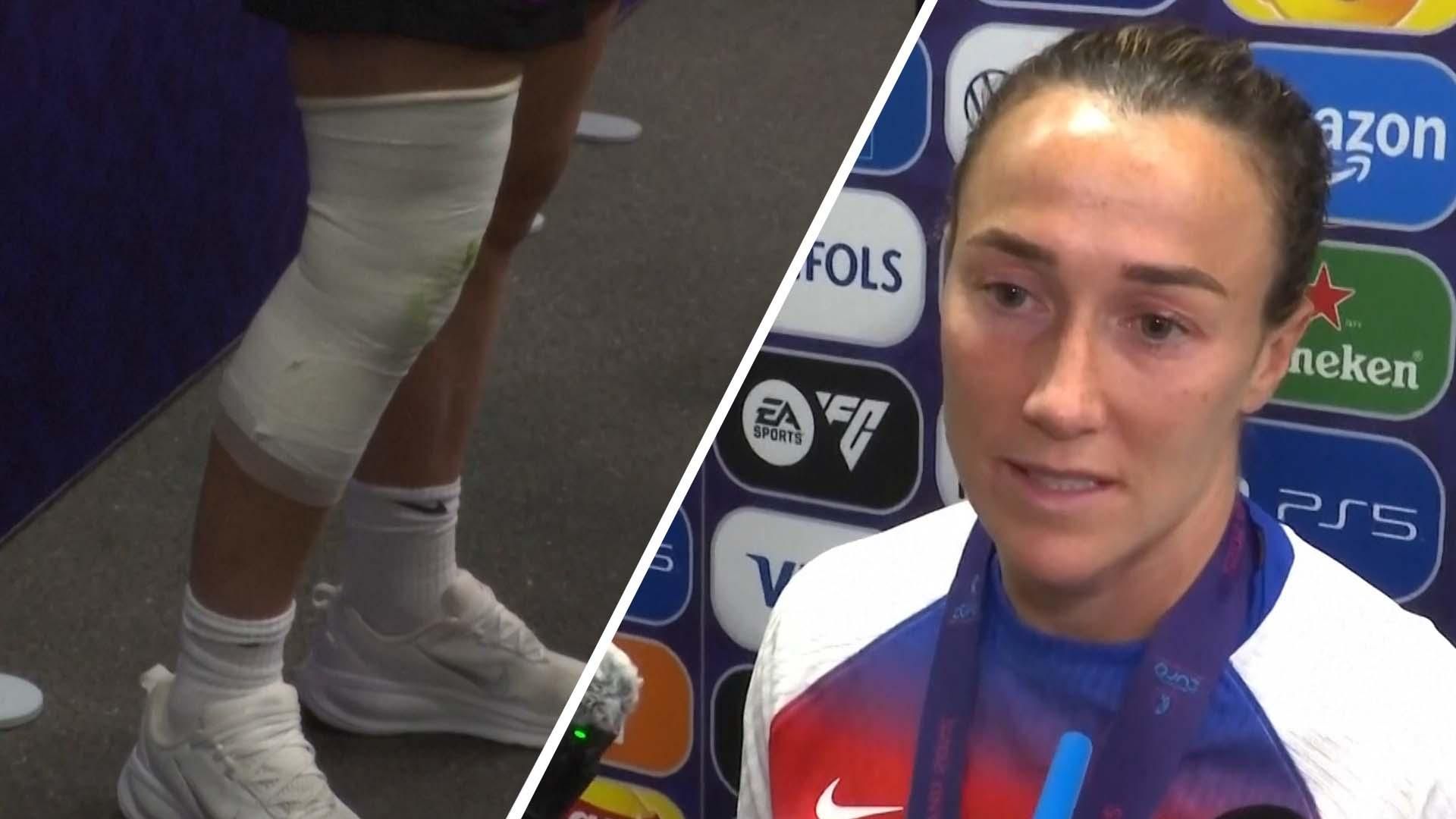 露西·布龙泽表示，她是在胫骨骨折的情况下参加了2025年欧洲杯的。